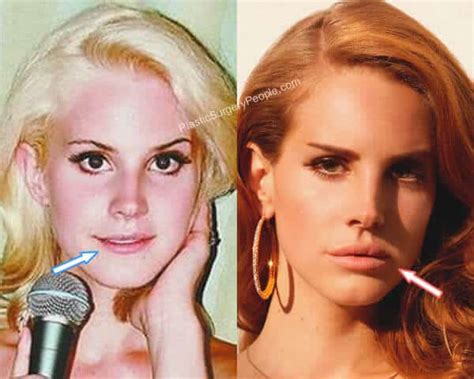 lana del rey lip injections.